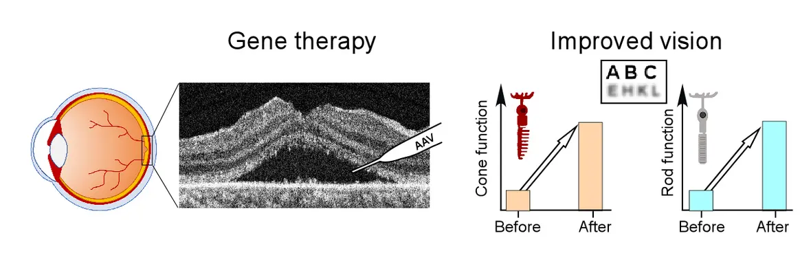 Eye, retina and results of gene therapy